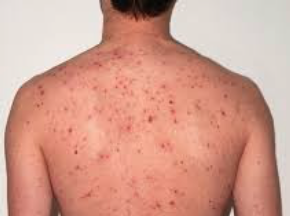 Image of a person's back with acne.