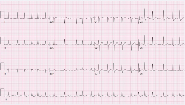 Sample ECG image for student assessment A sample 12-lead ECG that shows atrial fibrillation.