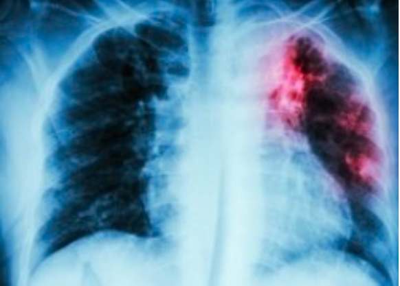 X-ray image of a chest cavity affected by tuberculosis.
