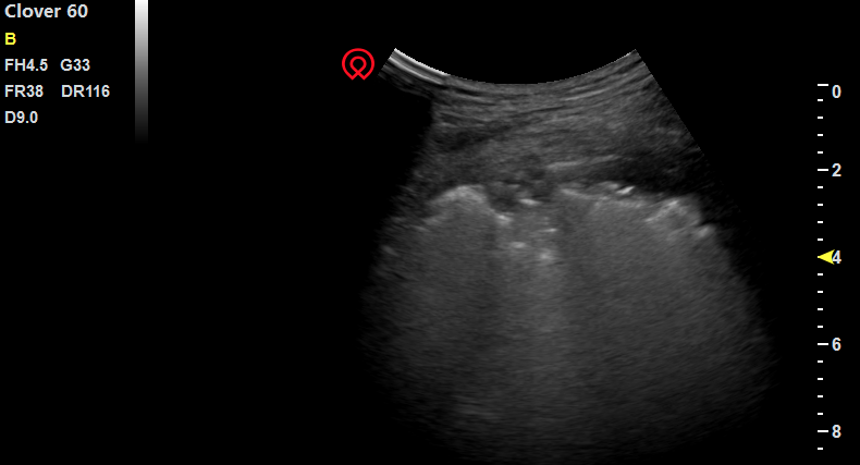 X-ray scan of lung ultasound