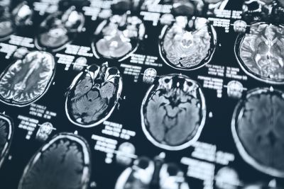Researchers have uncovered new brain mechanisms for PTSD. Image: iStockResearchers have uncovered new brain mechanisms for PTSD. Image: iStock