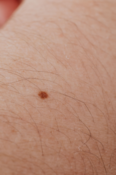 Sample medical image for student assessment A sample image showing a mole on a forearm