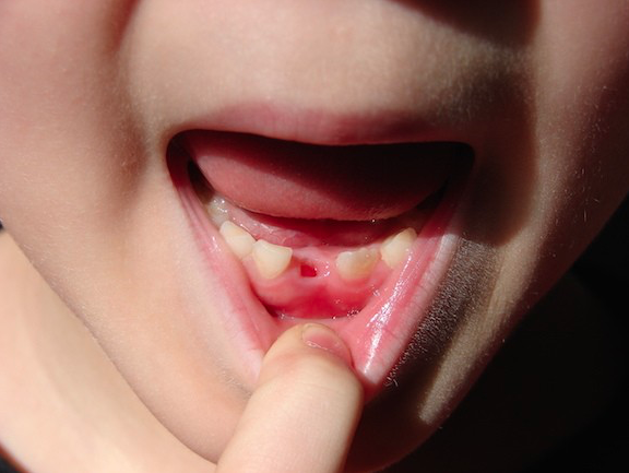Child tooth decay