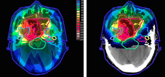 Brain imaging