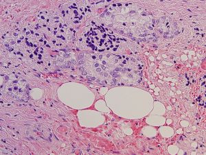 Fatty acids and prostate cancer cells and increase tumour growth