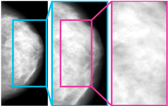 Mammogram hotspots